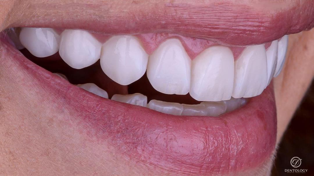 Diseño de Sonrisa en Polanco - Dentology Dental Boutique
